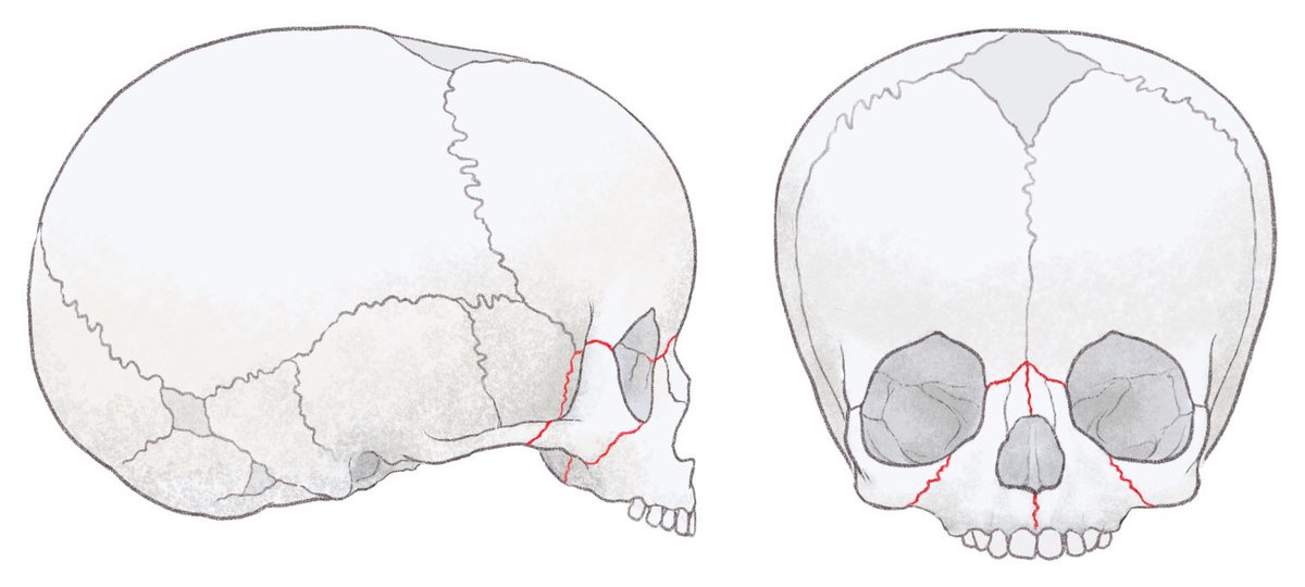 inoue_bonbon's tweet image. 🌸お仕事紹介
「改訂2版 小児の頭蓋健診・治療ハンドブック」
乳児の頭の形、運動の発達など、
診察のための専門書🤗
解説用の挿し絵のご依頼でした

曖昧にせず写実的に
かつ、温かみのあるタッチで

#乳児健診 #育児相談 #保健師 #助産師  #NICU #PT  #ヘルメット治療　 #イラストの依頼　#挿絵
