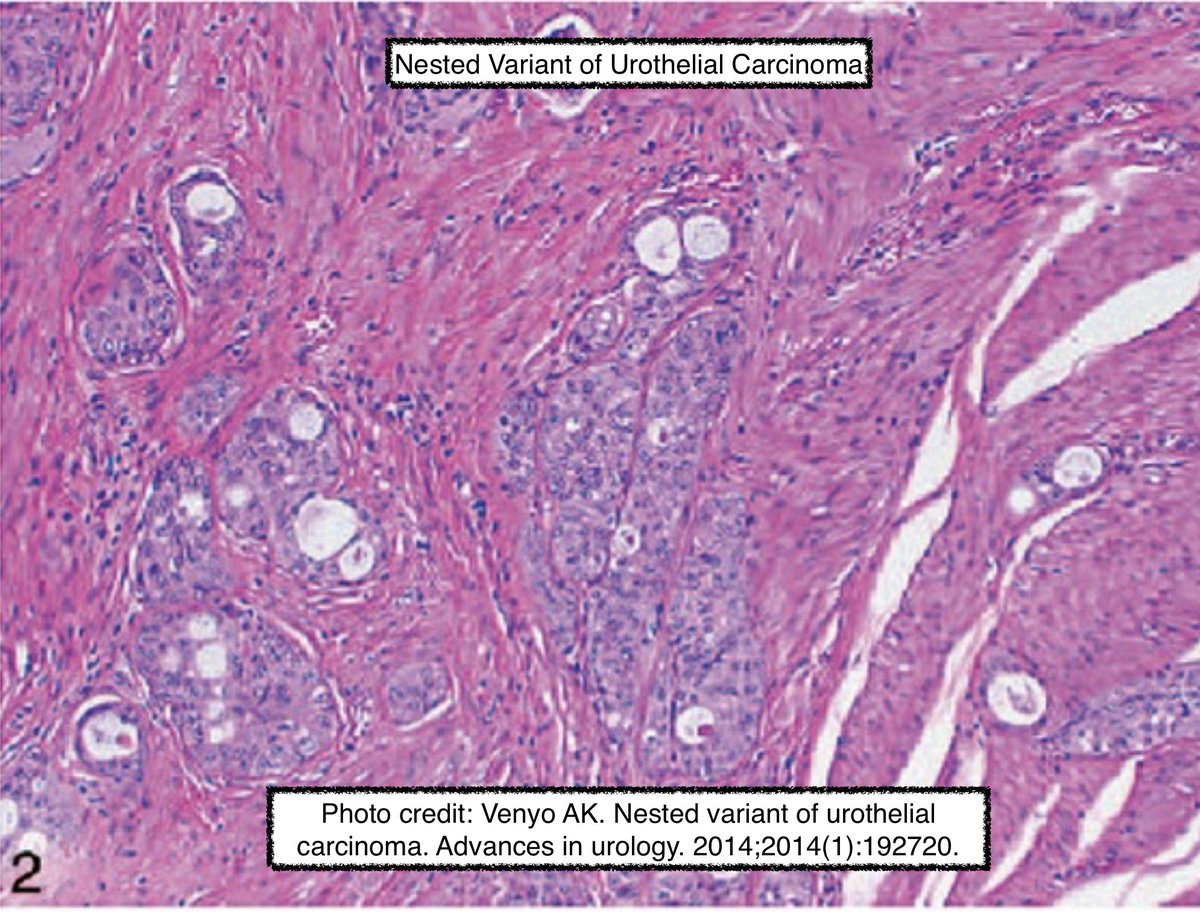 Path4People's tweet photo. 😨#PathPitFalls Nested Variant of Urothelial Carcinoma
🔬Cytologically bland but same clinical outcome: invasive high grade urothelial cancer
🔬👀 like Florid von Brunn nest
📉Rare; <1% of urothelial ca.
🔬Irregular sized nests, infiltrative (hard to appreciate on small biopsy) https://t.co/3nuhZe9hdV