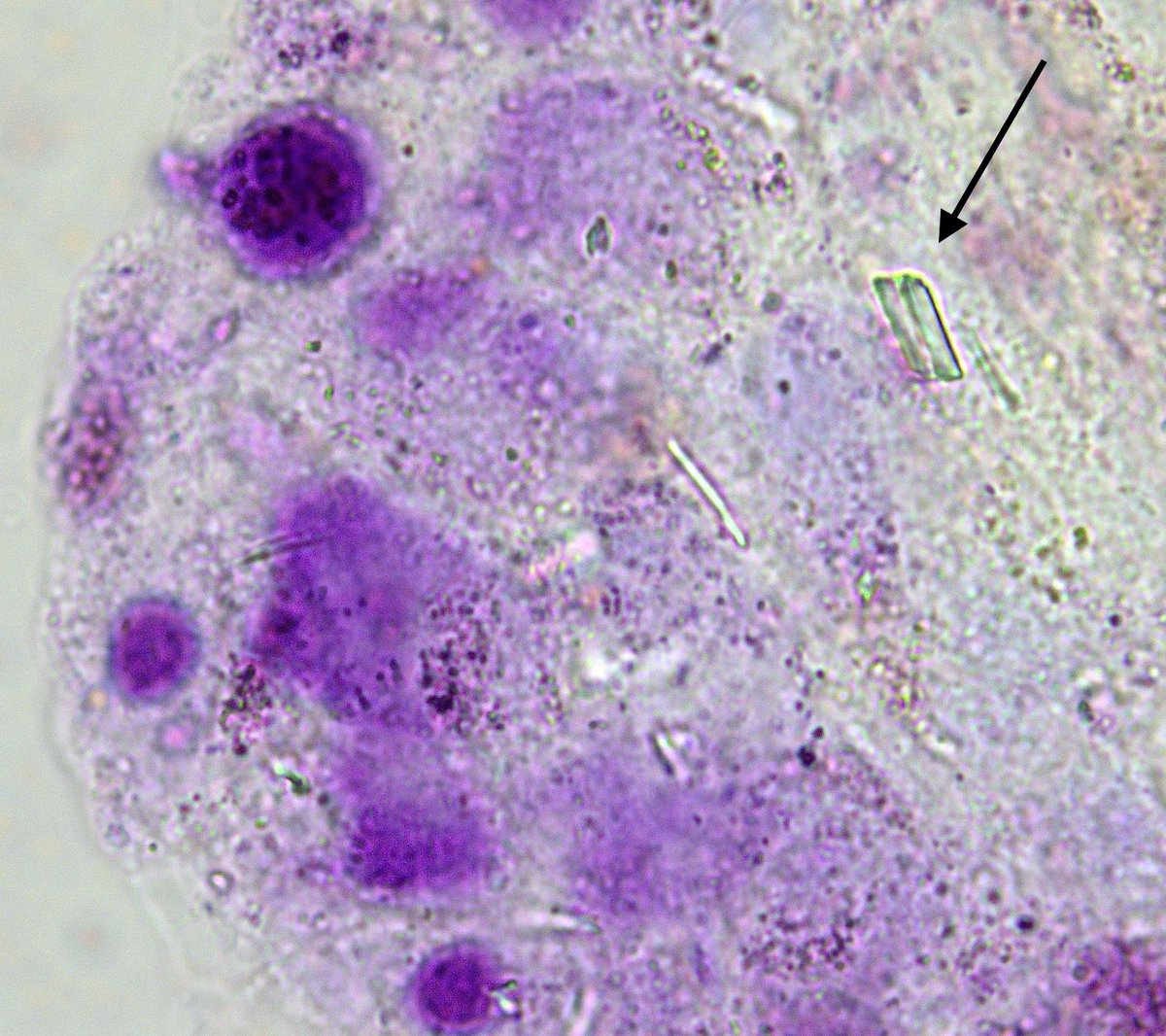 UnitPadova's tweet image. Is it really difficult-to-treat RA, or could it be something else? Synovial fluid analysis might hold the key!
@mariangelasalvato @DrAleeeG @francescaoliviero
#difficulttotreat #refractory #rheumatoidarthritis #RA