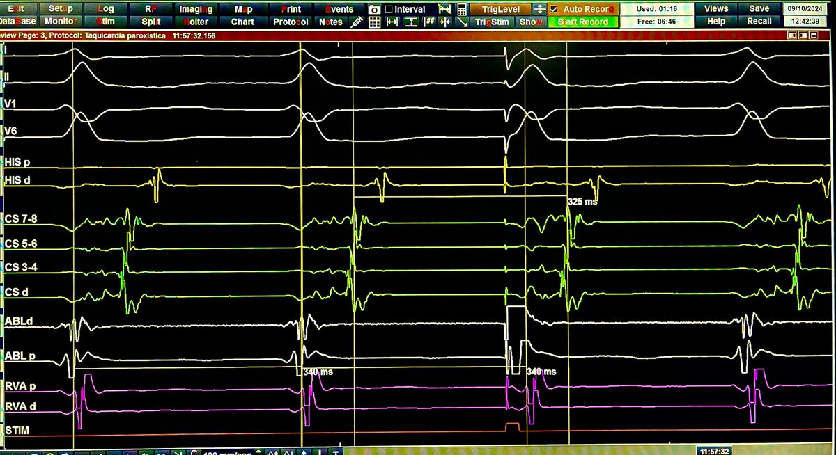 His-refractory PVC delivered from LV.

RV dissociation in  ORT using a left posterior AP. RV TCL remained unchanged.

Case from today at <a href="/hospitalposadas/">Hospital Posadas</a> 

This is the forth patient included and we can reproduce this phenomenon in all cases.