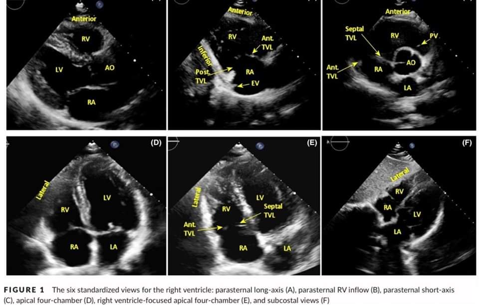 🔴“Echocardiographic assessment of the right ventricle in the current era: Application in clinical practice.” ⤵️ #2024Review 

🔹onlinelibrary.wiley.com/doi/10.1111/ec…
 #FOAMed #MedEd #medstudent #paramedic #Cardiology #CardioEd #medtwitter #meded #CardioTwitter #cardiotwiteros