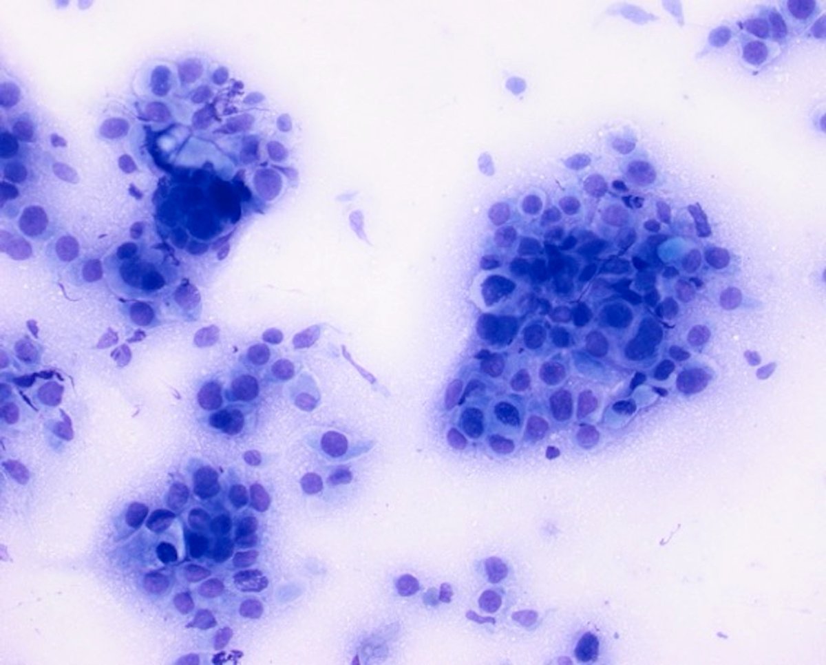 CuringN's tweet photo. Cytopathology - What's your diagnosis?
Topic link: https://t.co/9OyZ17XpG7
Images contributed by Reima El Naili, M.D.
Visit our CCN blog for cancer-related essays by Dr. Pernick: https://t.co/aaLBk9BA8J.
#Cancer #CancerResearch #CuringCancerNetwork #Pathology https://t.co/9C4Ywv4Izl