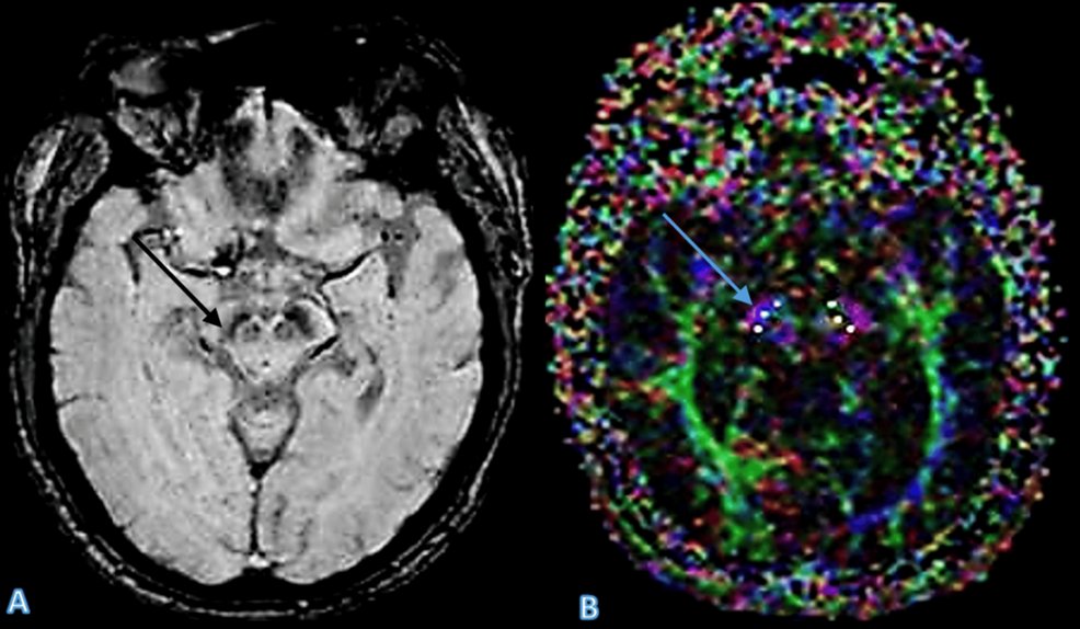 CureusNeuro's tweet photo. Is diffusion tensor imaging superior to conventional MRI in differentiating Parkinson’s disease from atypical parkinsonian syndromes?

🔗 https://t.co/EQNRJSckeg 

#Cureus #Neuroimaging #ParkinsonsDisease #DiffusionTensorImaging #Neurology #CaseReport https://t.co/S1kS1J8nqQ
