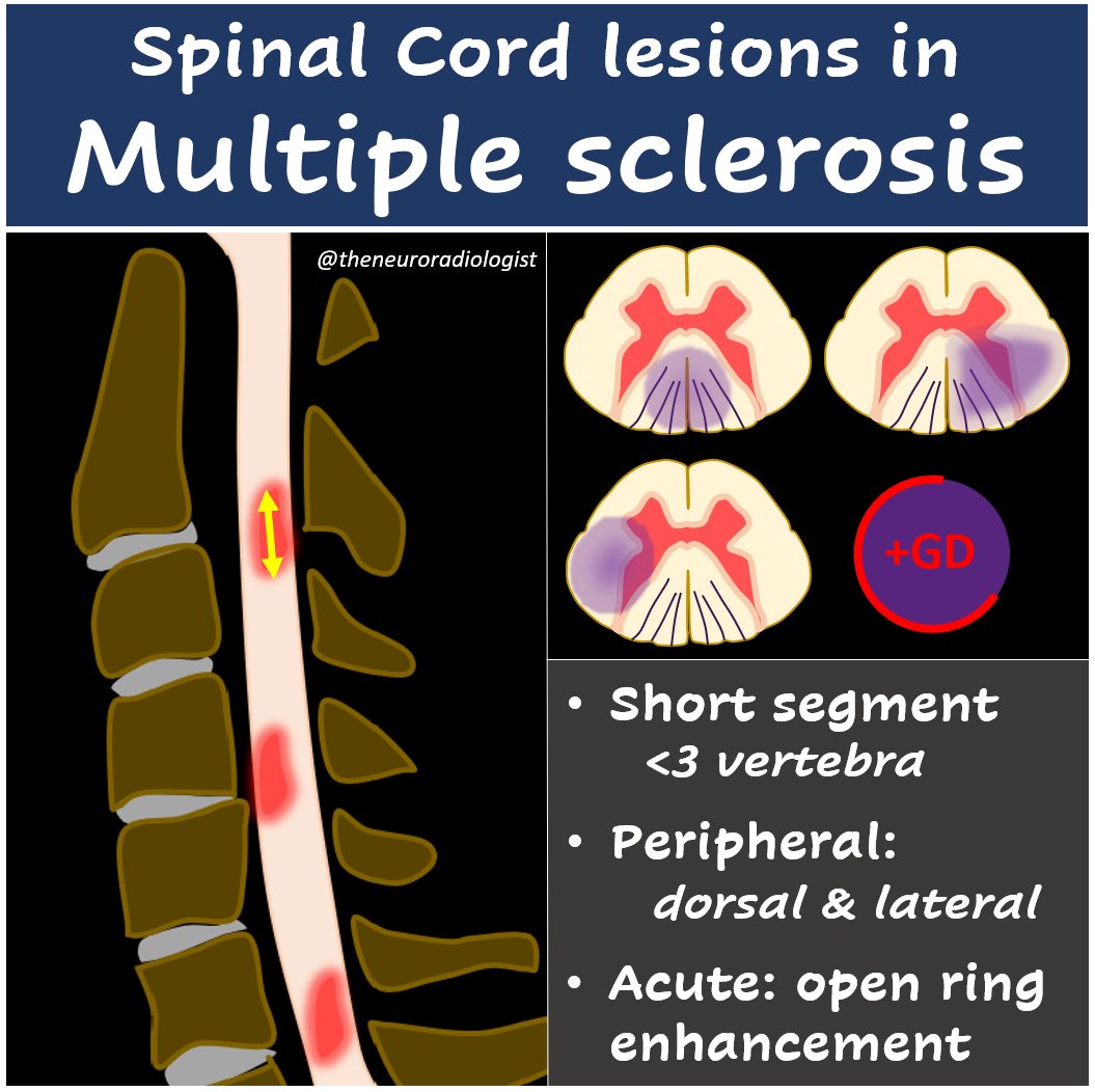 Typical for spinal cord lesions in MS is that they are short (spanning less than 3 vertebra, mostly much shorter) and are located eccentrically in the spinal cord (makes sense, that's where the white matter is). #FOAMed #FOAMrad #MedEd #RadED #radres #radiology
