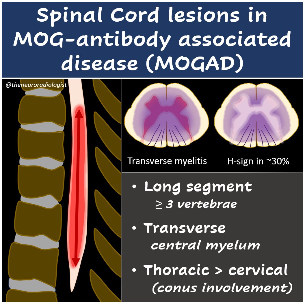 Myelitis in MOGAD is also a longitudinally extensive transverse myelitis (LETM) but located more often in the thoracic than cervical spinal cord (conus can be involved). The H-sign (more T2-hyperintense central gray matter) can be seen in ~30% of cases. #MedEd #FOAMed #radiology