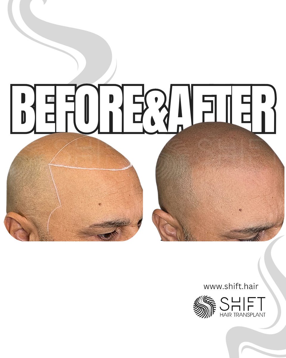 shifthairtr's tweet image. 🖤 Confidence in Every Shave! 🖤
Proudly showcasing the stunning results of scalp micropigmentation for the shaved look

#scalpmicropigmentation #micropigmentation #smp #micropigmentación #micropigmentazione #micropigmentaçao #mikropigmentierung #صبغ_الفروة_المجهري #shifthair