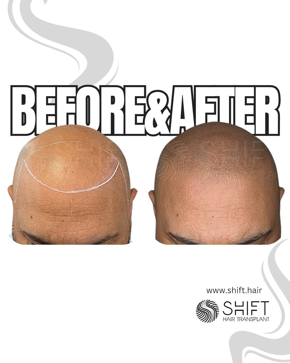 shifthairtr's tweet image. 🖤 Confidence in Every Shave! 🖤
Proudly showcasing the stunning results of scalp micropigmentation for the shaved look

#scalpmicropigmentation #micropigmentation #smp #micropigmentación #micropigmentazione #micropigmentaçao #mikropigmentierung #صبغ_الفروة_المجهري #shifthair