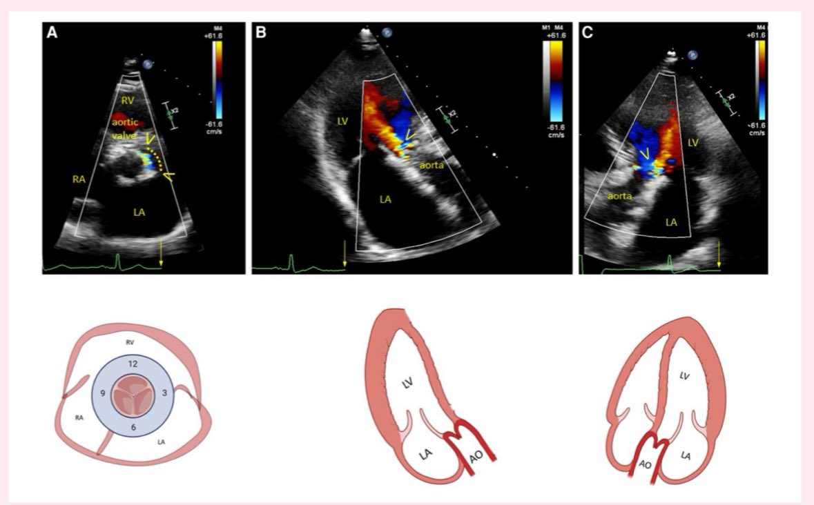 EHJ-IMP Editor-in-Chief (@ehjimpeic) on Twitter photo š„ Tips & Tricks on how to identify PVL post #TAVR š„ #EHJIMP academic.oup.com/ehjimp/article⦠<a href="/ESC_Journals/">European Society of Cardiology Journals</a> <a href="/escardio/">European Society of Cardiology</a> <a href="/OUPMedicine/">OUP Medicine</a> <a href="/alessia_gimelli/">Alessia Gimelli</a> <a href="/DrGEMandoli/">Giulia Elena Mandoli, MD, PhD, FESC, FISC</a> <a href="/ShehabAnwer/">Shehab Anwer, MD</a> <a href="/denisamuraru/">Denisa Muraru</a> <a href="/EZancanaroMD/">Edoardo Zancanaro MD</a> <a href="/Sarah_Moharem/">Sarah Moharem Elgamal, MBBCh, MSc, PhDš©š»āāļøš«</a> <a href="/saramoscatelli7/">Sara Moscatelli</a> <a href="/JGrapsa/">Julia Grapsa MD, PhD</a> <a href="/SaDeRosa78/">Salvatore De Rosa</a> <a href="/rafavidalperez/">rafavidalperez</a> <a href="/HanCardiomd/">Henry Han</a> š„ Tips & Tricks on how to identify PVL post #TAVR š„ #EHJIMP academic.oup.com/ehjimp/article⦠<a href="/ESC_Journals/">European Society of Cardiology Journals</a> <a href="/escardio/">European Society of Cardiology</a> <a href="/OUPMedicine/">OUP Medicine</a> <a href="/alessia_gimelli/">Alessia Gimelli</a> <a href="/DrGEMandoli/">Giulia Elena Mandoli, MD, PhD, FESC, FISC</a> <a href="/ShehabAnwer/">Shehab Anwer, MD</a> <a href="/denisamuraru/">Denisa Muraru</a> <a href="/EZancanaroMD/">Edoardo Zancanaro MD</a> <a href="/Sarah_Moharem/">Sarah Moharem Elgamal, MBBCh, MSc, PhDš©š»āāļøš«</a> <a href="/saramoscatelli7/">Sara Moscatelli</a> <a href="/JGrapsa/">Julia Grapsa MD, PhD</a> <a href="/SaDeRosa78/">Salvatore De Rosa</a> <a href="/rafavidalperez/">rafavidalperez</a> <a href="/HanCardiomd/">Henry Han</a>