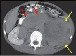 Satyayadav__'s tweet image. #ChildhoodCancerAwarenessMonth

Day 11 

Kidney tumor in children is commonly Nephroblastoma also called #WilmsTumor is highly curable 

Usually diagnosed 

- incidentally by mother while bathing the child 

- abdominal lump 

- blood in urine 

researchgate.net/publication/23…