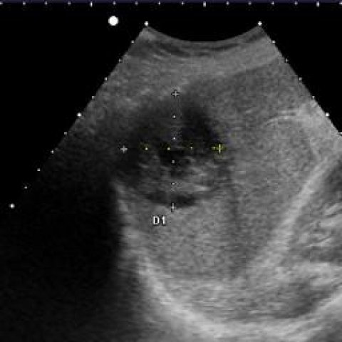 ماهو تشخيصكم لهذه الحالة ؟؟

🚨المريض يعاني من ارتفاع في الحرارة وزيادة عدد كريات الدم البيضاء.
-العضو هنا هو الطحال.