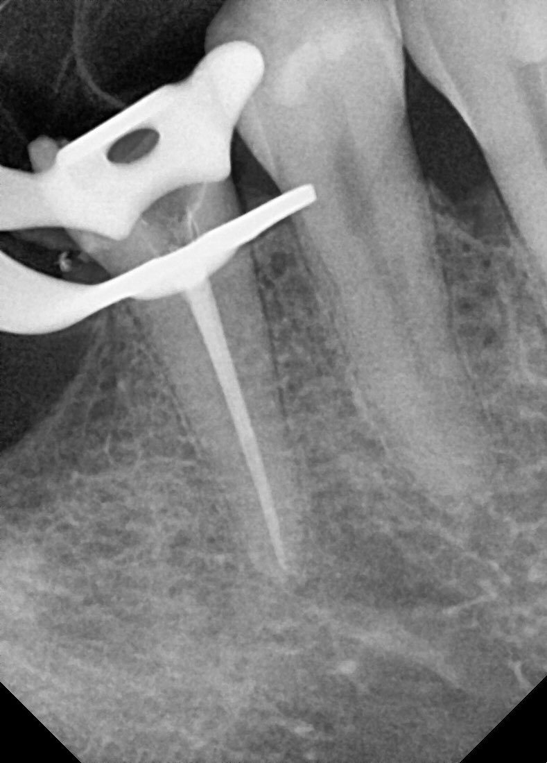Endo. case 🦷

Tooth #45

Dx : previously RC treated

Clinical examination: partial crown fracture, coronal leakage 

Radiographic examination: short obturation 

Planned for : retreatment, post &amp; core followed by crown