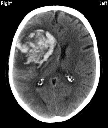 hemo_shk's tweet photo. #CT_BRAIN:
Patient presents with headache and left sided limb weakness.
What is the cause?
Diagnosis?
#MEDHM #MEDX @IhabFathiSulima https://t.co/30nWj2ouug