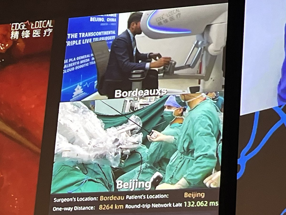 Prof. Prokar Dasgupta OBE (@prokarurol) on Twitter photo Telesurgery at #ERUS24
<a href="/AlbertoBreda1/">Alberto Breda</a> in his suit and tie (why not!) performs a robotic partial nephrectomy from Bordeaux to Beijing with the Edge Medical robot
8000km+ each way
132 milliseconds delay
Real time monitoring
The future??? Telesurgery at #ERUS24
<a href="/AlbertoBreda1/">Alberto Breda</a> in his suit and tie (why not!) performs a robotic partial nephrectomy from Bordeaux to Beijing with the Edge Medical robot
8000km+ each way
132 milliseconds delay
Real time monitoring
The future???
