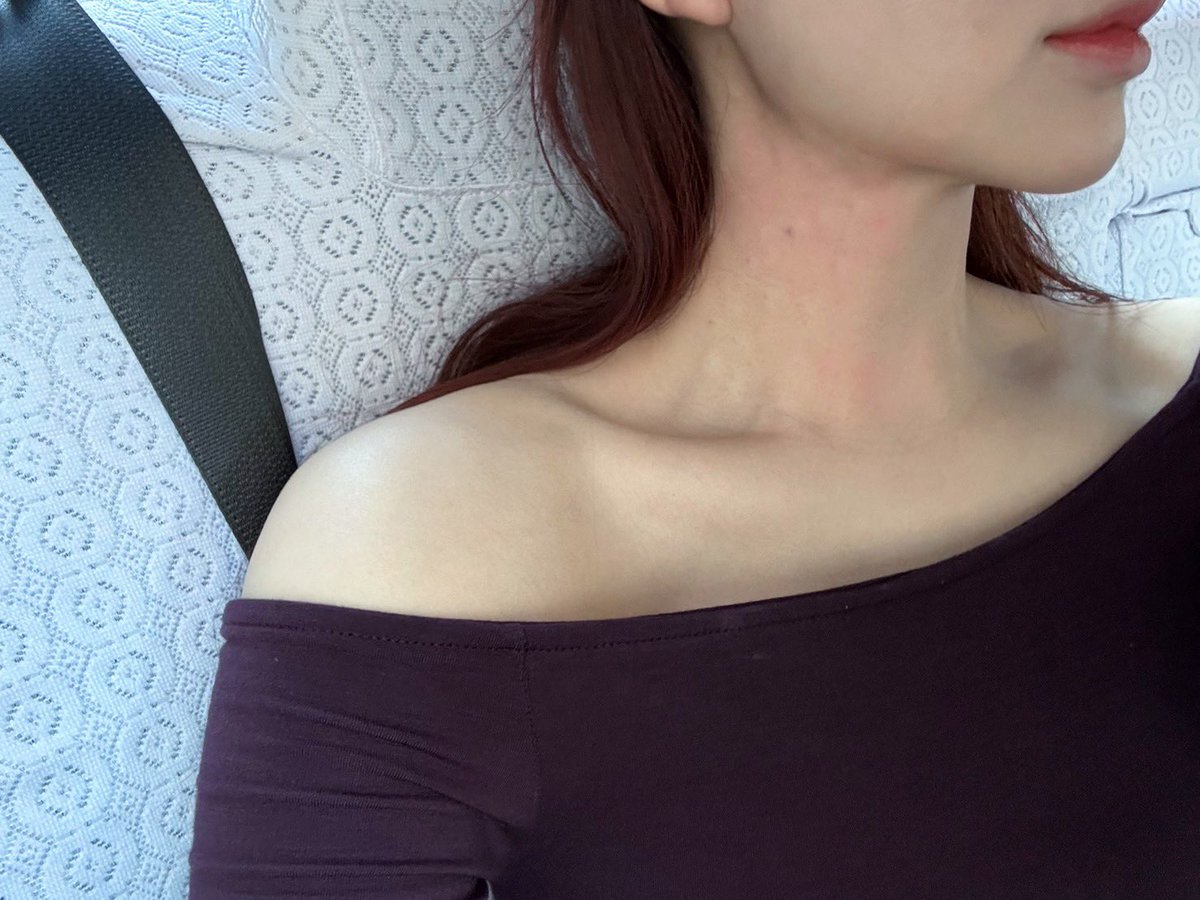 chika_biyouhihu's tweet photo. 教えてもらったのでメモ📝

ネックリフト＝首ボト＝広頚筋ボト
ネックスリム＝首ボト＝胸鎖乳突筋ボト

肩ボト僧帽筋上部の盛り上がりが強い部分にのみが一般的
バービーボトックス＝僧帽筋全体に打ち込む

メリットは首肩周りが細くなる
デメリットは筋トレができない,起き上がれなくなる

今回初めてなので、胸鎖乳突筋は少なめにしときますとのことでした！
直後は、ほんのり赤みと膨らみが少し見える程度でそこまで問題ないと思います🙆🏻