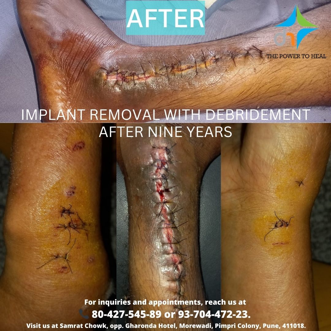 DivineHosital's tweet photo. A Journey of Resilience and Healing! 💪🏥
At Divine Super Speciality Hospital, we are proud to offer life-changing treatments, guiding patients from severe injuries to full recovery.
For inquiries and appointments, reach us at:
📞 80-427-545-89 or 93-704-472-23
#PatientCare https://t.co/z6q2E3eQsx
