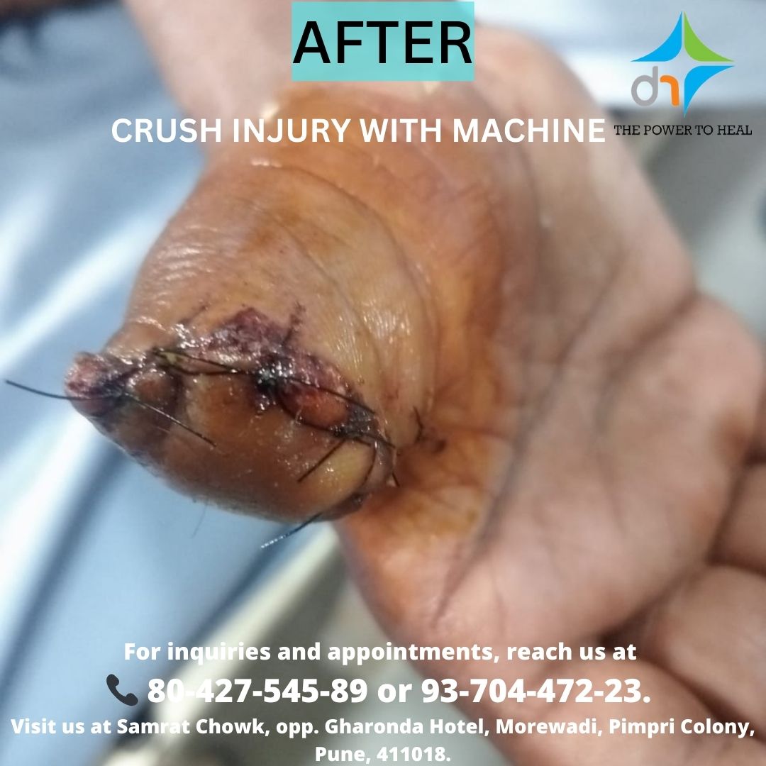 DivineHosital's tweet photo. A Journey of Resilience and Healing! 💪🏥
At Divine Super Speciality Hospital, we are proud to offer life-changing treatments, guiding patients from severe injuries to full recovery.
For inquiries and appointments, reach us at:
📞 80-427-545-89 or 93-704-472-23
#PatientCare https://t.co/z6q2E3eQsx