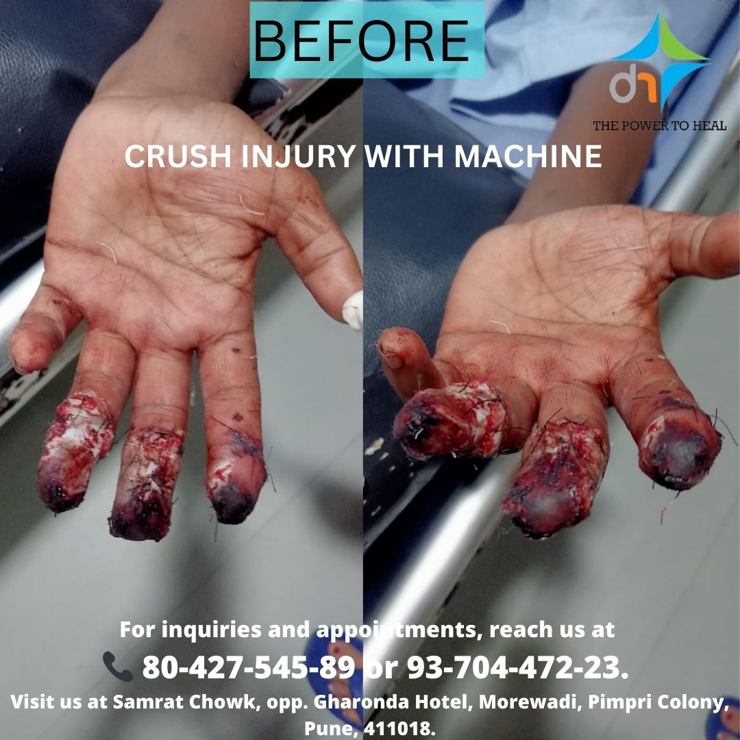 DivineHosital's tweet photo. A Journey of Resilience and Healing! 💪🏥
At Divine Super Speciality Hospital, we are proud to offer life-changing treatments, guiding patients from severe injuries to full recovery.
For inquiries and appointments, reach us at:
📞 80-427-545-89 or 93-704-472-23
#PatientCare https://t.co/z6q2E3eQsx