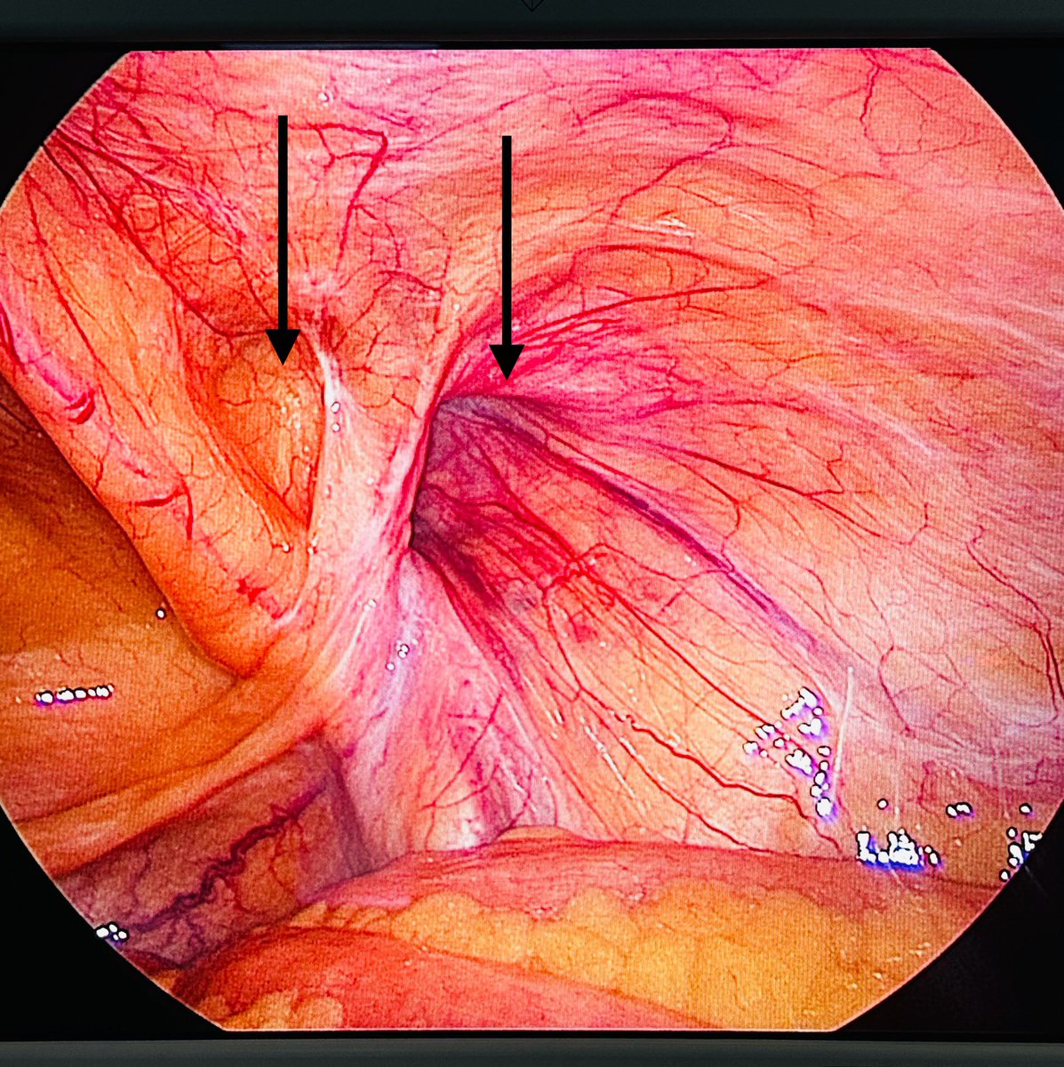 Lap_surgeon's tweet image. Laparoscopic image of inguinal hernia!👇

#MedTwitter 
What is the name of this hernia??