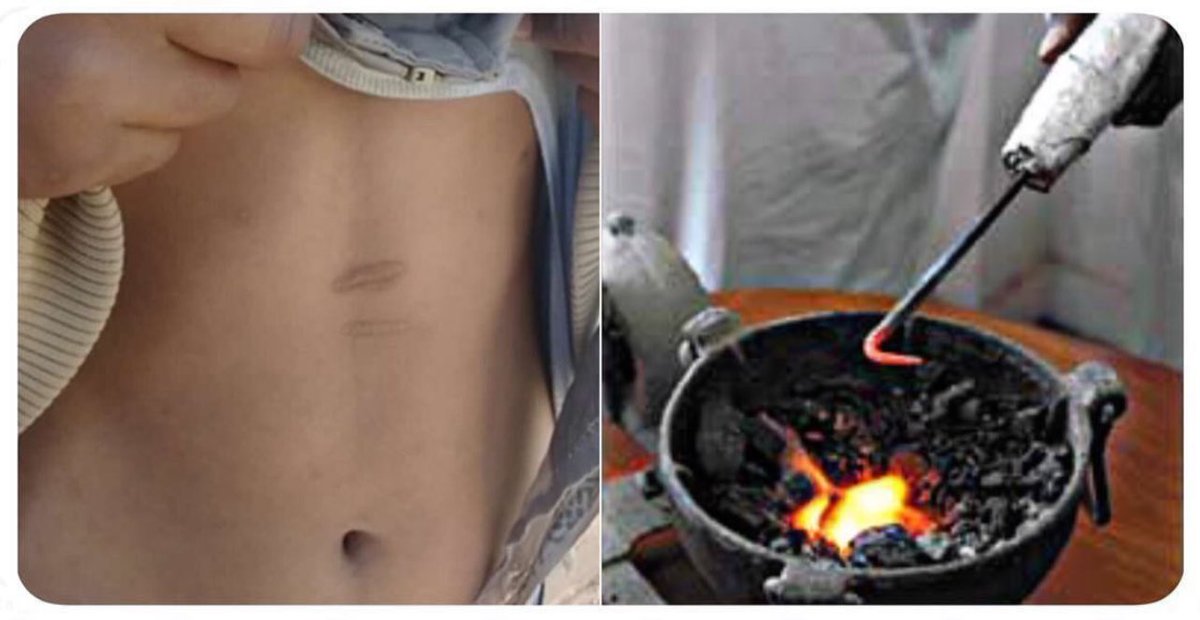 في أحد الأيام أجرينا لمريض عملية جراحية لإزالة #ورم_قولون متقدم و خلال العمليه قمنا بإزالة القولون و جزء من الأمعاء و جزء من المثانه كون ان الورم متقدم جدا، الغريب هو ان هذا المريض عانى من امساك شديد لفترة تقارب الخمسة اشهر قبل العملية مصحوبا بنزيف من وقت إلى آخر ولكنه لم يتوجه