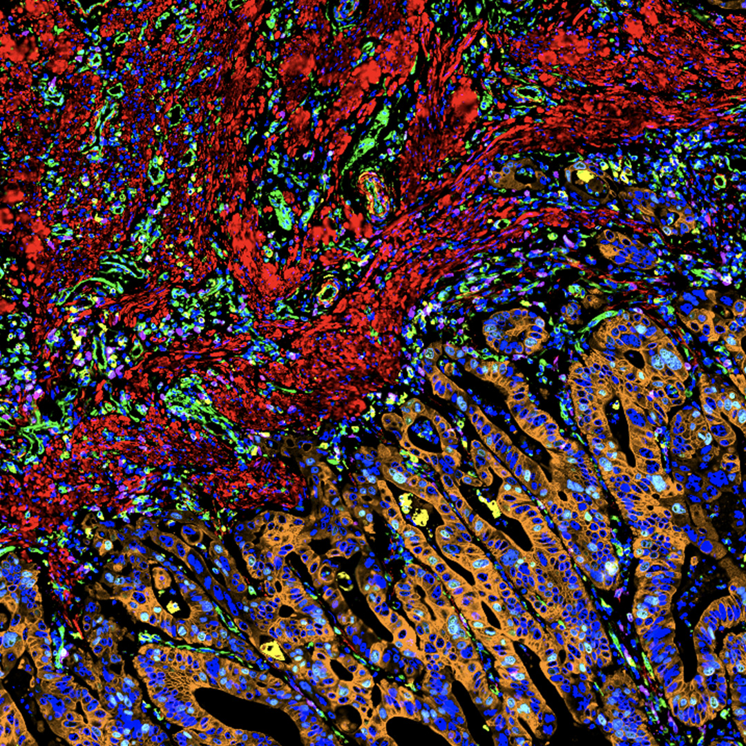 LeicaMicro's tweet photo. Dive into colon adenocarcinoma tissue using #CellDIVE and #Aivia to understand the tumor microenvironment. Learn how accurate segmentation and automatic clustering offer pathways to deeper insights.
👉️ https://t.co/K8xcSAAn60 https://t.co/0qkXrbek7D