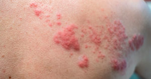 NEJMClinician's tweet photo. Chronic varicella-zoster virus brain infection might trigger #dementia, and vaccination against shingles was associated with lower subsequent risk for vascular dementia or Alzheimer disease. https://t.co/kwHwMlWlUL

#IDTwitter https://t.co/iFIDNcTsie