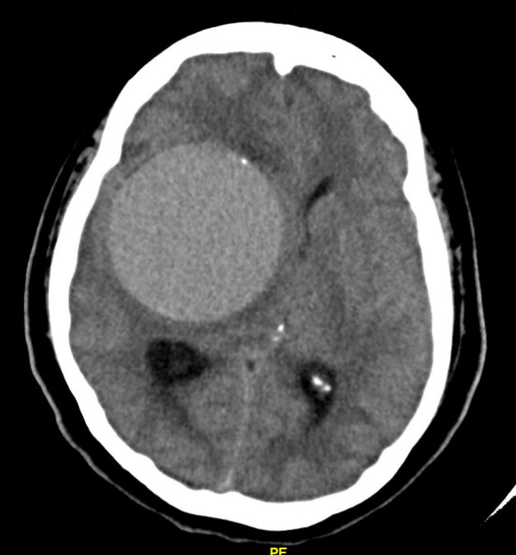 Thoughts on this lesion? <a href="/ChavezRamzes/">Ramzes Chavez MD</a>