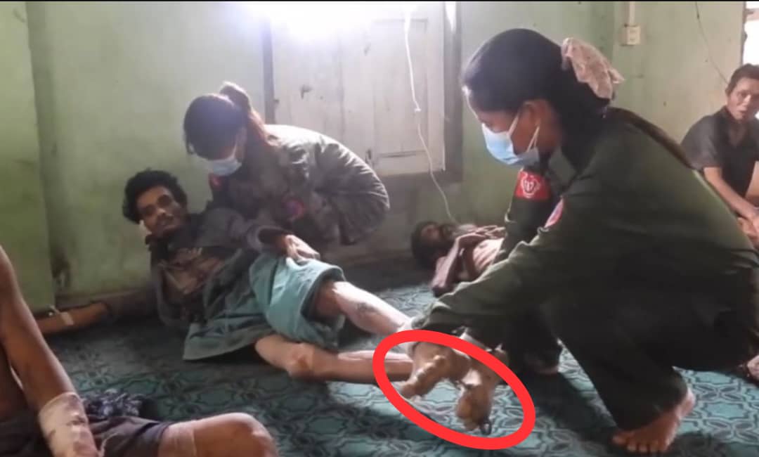 KMojibur74818's tweet photo. Do you see a chain tied with his leg? Where they escape from the bombardments? More #Rohingya innocent civilian captives have been detaining by #AA terrorists. Some were bombed and some are alive in the prison of AA terrorists.

Do you see how the captives surviving without food? https://t.co/uR0ZPFDrzi