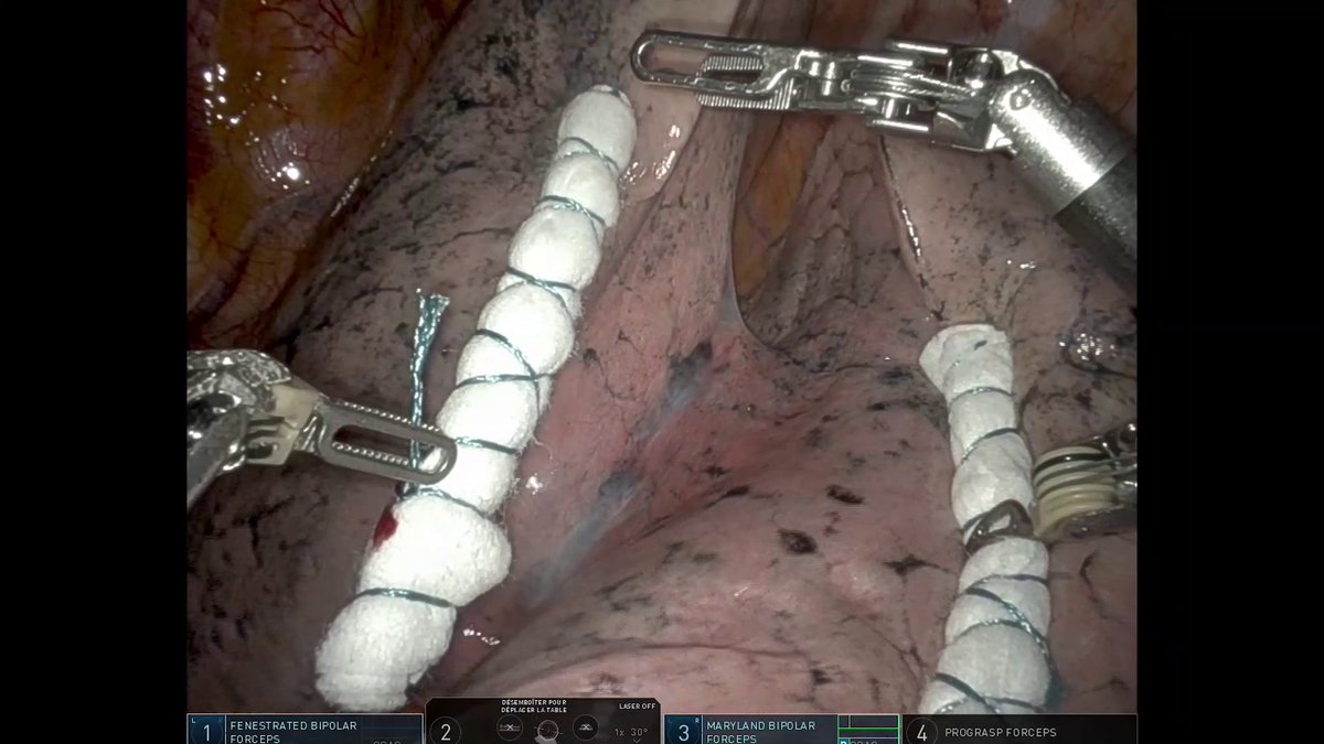 “Robotic-Assisted Left Lower Lobectomy for NSCLC After Neoadjuvant Chemoimmunotherapy” | This video describes a robotic-assisted left lower lobectomy and radical lymphadenectomy performed with the Da Vinci Xi surgical system.

🔗ow.ly/CmEm50TkhC8