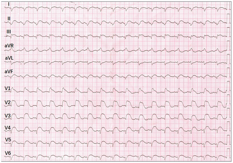 SeguraCardio's tweet image. Woman in her mid-20s with chest pain. What&apos;s your diagnosis &amp;amp; management?

#ECGChallenge