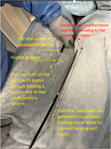 VideoGIE Journal (@videogie) on Twitter photo From this month's issue of VideoGIE: "Towing the stent to manage malignant gastro-entero-colonic fistula and colonic obstruction" by Mayank Goyal et al. videogie.org/article/S2468-…
<a href="/NavButtarMD/">Nav Buttar MD</a> 
<a href="/KaraRaphael/">Kara Raphael</a> From this month's issue of VideoGIE: "Towing the stent to manage malignant gastro-entero-colonic fistula and colonic obstruction" by Mayank Goyal et al. videogie.org/article/S2468-…
<a href="/NavButtarMD/">Nav Buttar MD</a> 
<a href="/KaraRaphael/">Kara Raphael</a>