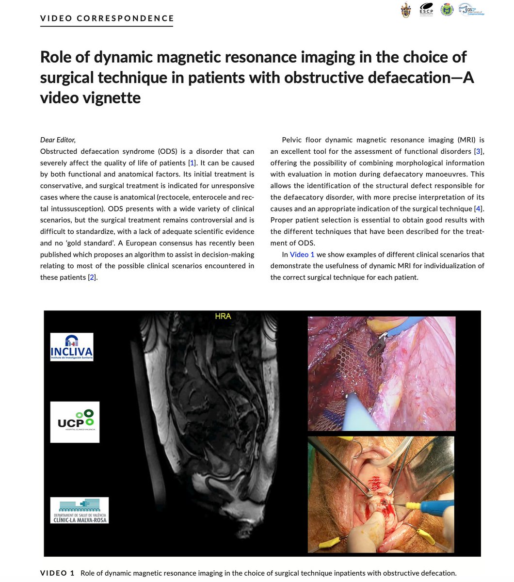 Vicente Pla Marti (@vicenteplamarti) on Twitter photo Role of dynamic MRI in the surgical indication of obstructive defecation syndrome . We are pleased to share our <a href="/ColorectalDis/">Colorectal Disease</a> video publication. <a href="/ClinicoUcp/">UCP Hospital Clínico Valencia</a> <a href="/GVAclinic/">Hospital Clínic de València</a> <a href="/incliva_iis/">INCLIVA</a>
lnkd.in/drEbrxMY
lnkd.in/dCBZp3Bh Role of dynamic MRI in the surgical indication of obstructive defecation syndrome . We are pleased to share our <a href="/ColorectalDis/">Colorectal Disease</a> video publication. <a href="/ClinicoUcp/">UCP Hospital Clínico Valencia</a> <a href="/GVAclinic/">Hospital Clínic de València</a> <a href="/incliva_iis/">INCLIVA</a>
lnkd.in/drEbrxMY
lnkd.in/dCBZp3Bh