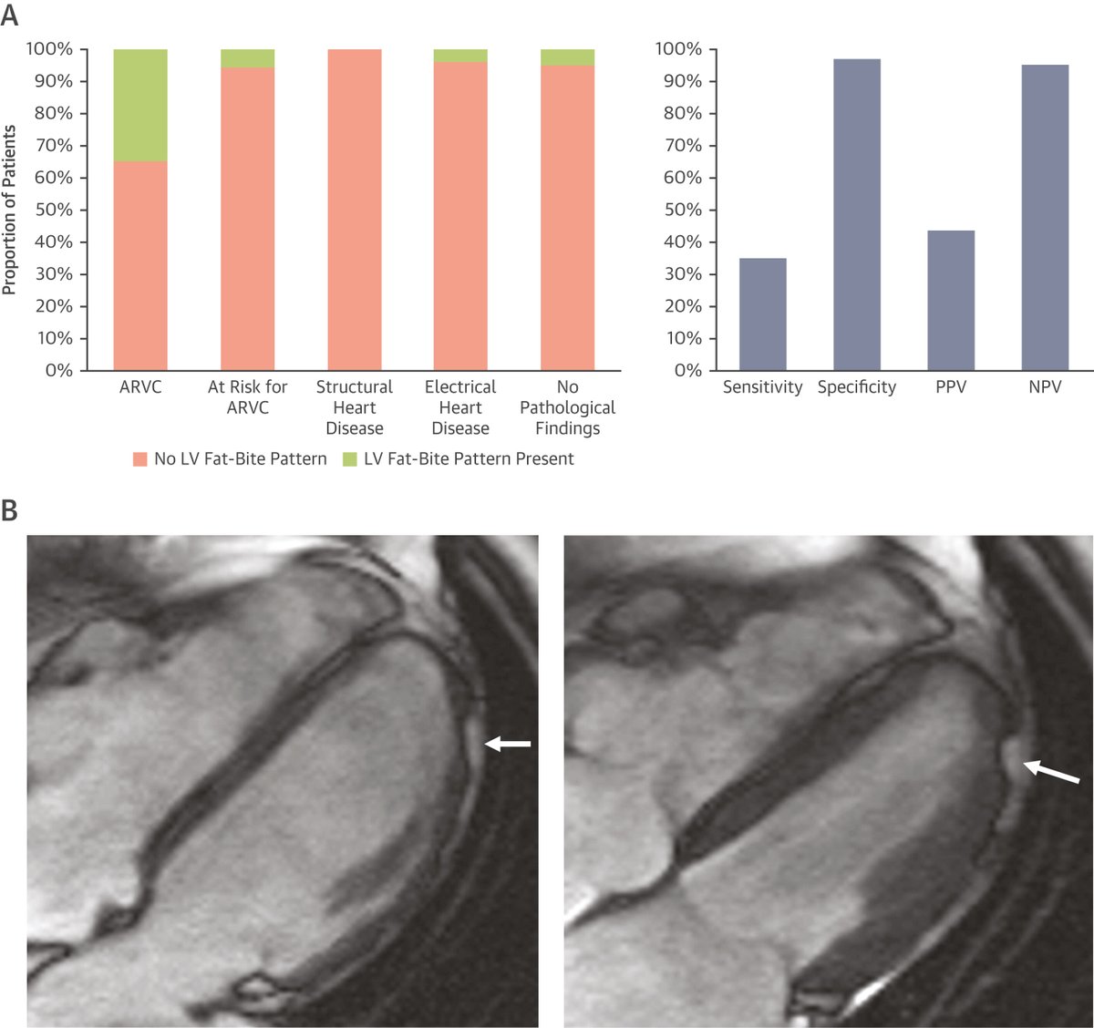JACC Journals (@jaccjournals) on Twitter photo #JACCIMG #cvImaging pearl: LV "fat-bite" pattern on #whyCMR has a high specificity for diagnosis of arrhythmogenic right ventricular #cardiomyopathy. bit.ly/4e1Bo3U
<a href="/BabkenAsatryan/">Babken Asatryan, MD, PhD</a> <a href="/CardiacRad/">Stefan Zimmerman</a> #ARVC #JACCIMG #cvImaging pearl: LV "fat-bite" pattern on #whyCMR has a high specificity for diagnosis of arrhythmogenic right ventricular #cardiomyopathy. bit.ly/4e1Bo3U
<a href="/BabkenAsatryan/">Babken Asatryan, MD, PhD</a> <a href="/CardiacRad/">Stefan Zimmerman</a> #ARVC