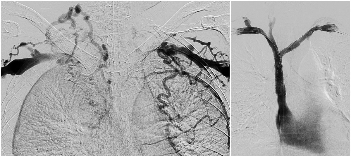 Jeffrey F. B. Chick, MD, MPH (@chickvir) on Twitter photo Superior vena cava (SVC) syndrome has various causes. Although malignancy accounts for 60% of cases, the prevalence of benign etiologies has been increasing. Endovascular SVC recanalization has become a major treatment option.
<a href="/CVIR_Journal/">CVIR Journal</a> <a href="/JVIRmedia/">JVIR</a> <a href="/cvirendo/">CVIR Endovascular (Jim Reekers, Editor-in-Chief)</a> <a href="/AcademicRad/">ā¢ļøAcademic Radiology</a> Superior vena cava (SVC) syndrome has various causes. Although malignancy accounts for 60% of cases, the prevalence of benign etiologies has been increasing. Endovascular SVC recanalization has become a major treatment option.
<a href="/CVIR_Journal/">CVIR Journal</a> <a href="/JVIRmedia/">JVIR</a> <a href="/cvirendo/">CVIR Endovascular (Jim Reekers, Editor-in-Chief)</a> <a href="/AcademicRad/">ā¢ļøAcademic Radiology</a>