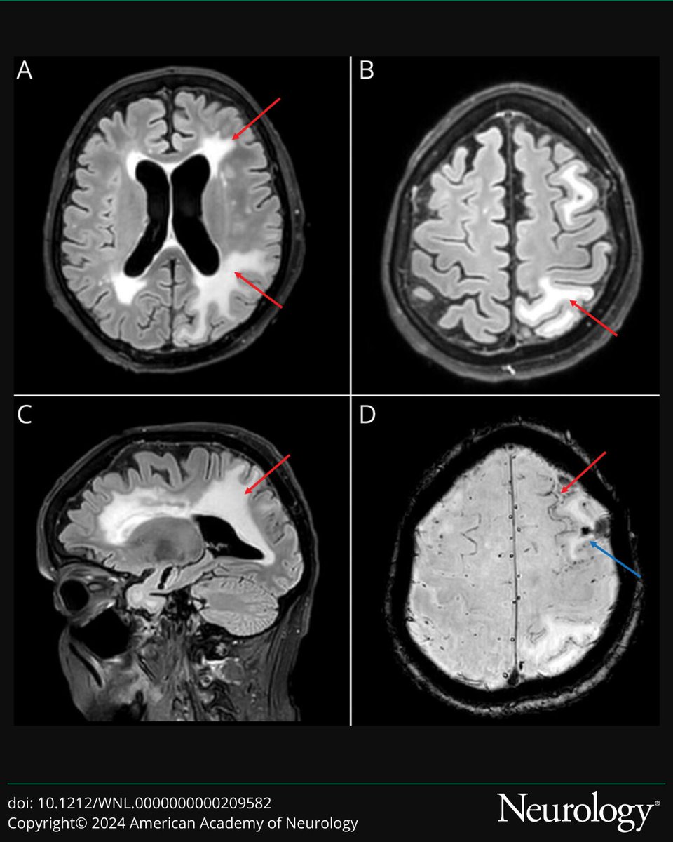 This Clinical/Scientific Note reports a case of fatal super-refractory status epilepticus associated with amyloid-related imaging abnormalities (#ARIA): bit.ly/4fVZnm7

#NeuroTwitter