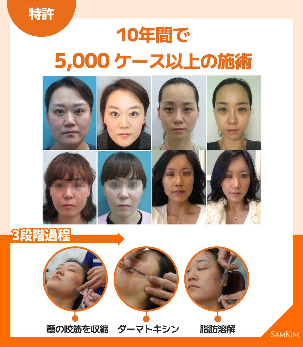 bflinebfline's tweet photo. <<卵注射>>
by SAMKIM医院
6つの薬物組成物で特許を取得！
たった一人だけ施術可能! SAMKIM院長！
エラボトックスで解決できない死角地帯まで解決

Vライン完成‼️‼️

10年間で5,000ケース以上の施術

#SAMKIM医院 #卵注射 #Vライン https://t.co/fL8WRg8pDV