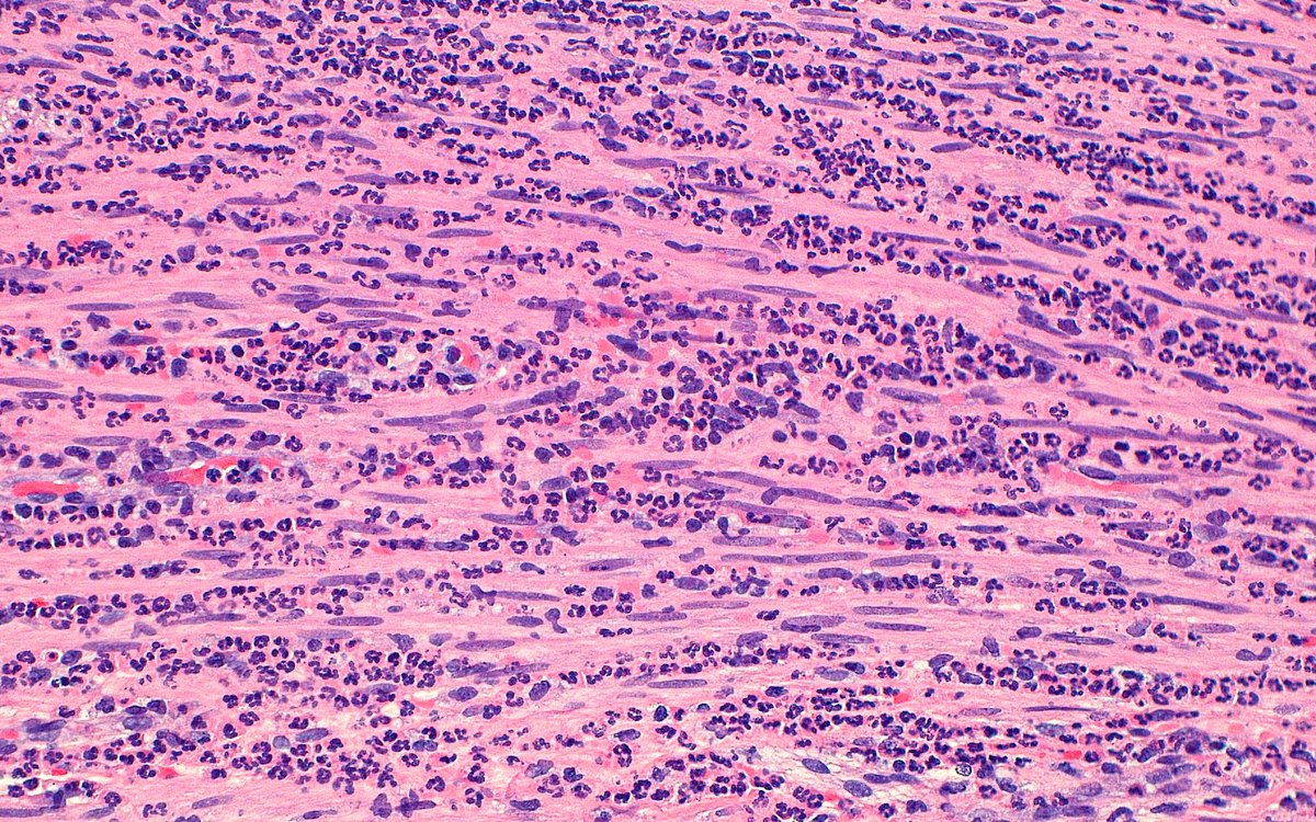 🔬 Smooth muscle and neutrophils ~ Acute Appendicitis ~ #GIpath #Pathology #PathologyBasics
