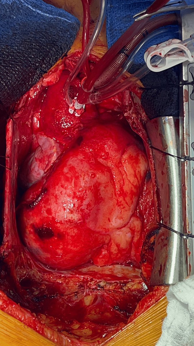 Thrilled to our latest case report: Successfully managed a ruptured giant right coronary artery aneurysm with atrial fistula.

Q: How can we improve early detection of coronary artery aneurysms?

Read more here: cureus.com/articles/24854…

#CardiacSurgery #CoronaryArteryAneurysm