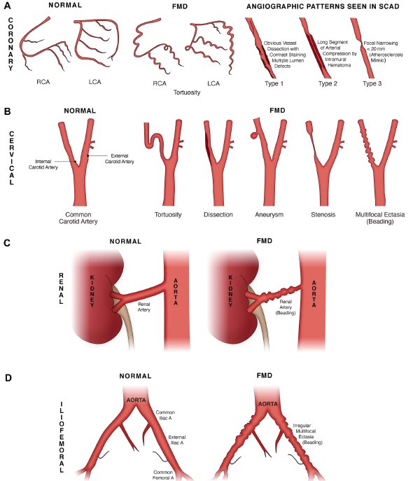 Mina Madan (@minamadanmd) on Twitter photo Calling all cardiologists! How will YOU counsel your SCAD pt with newly diagnosed FMD? Read our focused review in CJCO: https:/doi.org/10.1016/j.cjco.2024.07.014 <a href="/docsaw/">Jacqueline Saw</a> <a href="/UofT_DoM/">Department of Medicine University of Toronto</a> <a href="/Sunnybrook/">Sunnybrook Health Sciences Centre</a> <a href="/WomenAs1/">Women As One</a> <a href="/TPetropoulosMD/">Taylor Petropoulos</a> <a href="/ajlavoie4hearts/">AJ</a> Calling all cardiologists! How will YOU counsel your SCAD pt with newly diagnosed FMD? Read our focused review in CJCO: https:/doi.org/10.1016/j.cjco.2024.07.014 <a href="/docsaw/">Jacqueline Saw</a> <a href="/UofT_DoM/">Department of Medicine University of Toronto</a> <a href="/Sunnybrook/">Sunnybrook Health Sciences Centre</a> <a href="/WomenAs1/">Women As One</a> <a href="/TPetropoulosMD/">Taylor Petropoulos</a> <a href="/ajlavoie4hearts/">AJ</a>