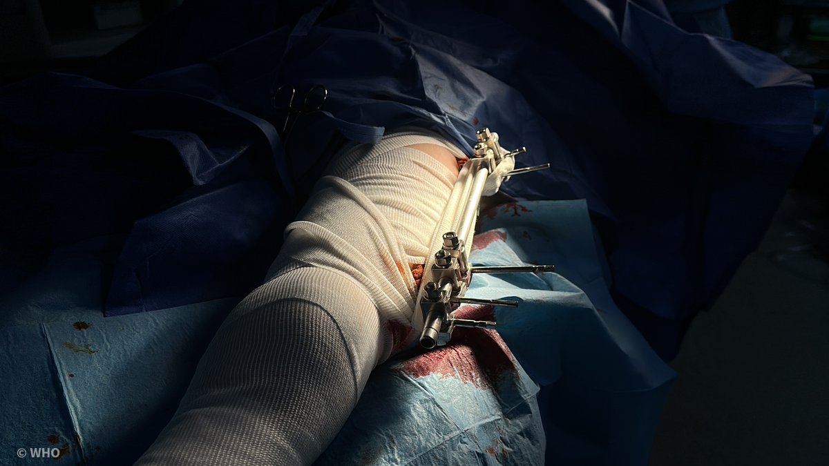 🆕 At least one quarter of the people injured in #Gaza are estimated to have life-changing injuries that require rehabilitation services now and for years to come: WHO report bit.ly/3AYkEvN