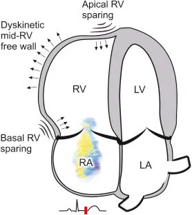 Pulmonary embolism (McConnell sign):

Regional right ventricular dysfunction in acute

Note dyskinesis of mid right ventricular free wall (blue arrows) and relative sparing of the apex and the base (green arrows) .

 LA , Left atrium; LV , left ventricle; RA , right atrium; RV ,