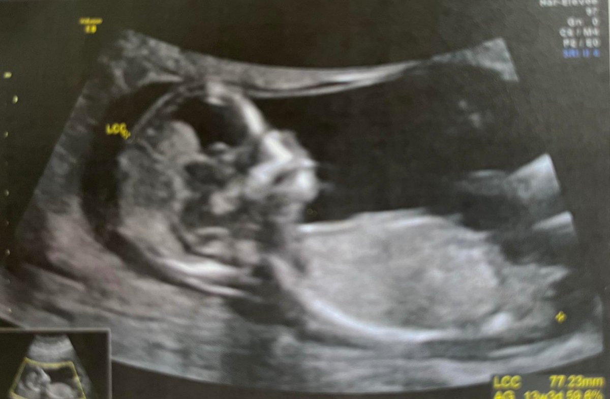 COrl_UnOd's tweet photo. Bon je l'ai gardé assez longtemps pour moi, 5 mois. Il est temps que je l'annonce ici car ma vie va être bientôt bouleversé. Je vais être papa 🧑‍🍼 https://t.co/xpPPWuj1aa