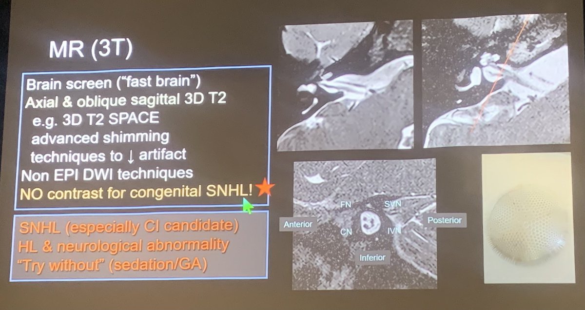 ESHNR (@eshnrsociety) on Twitter photo CT&MR imaging techniques of the congenital malformations of the inner ear by <a href="/callyrobs/">Caroline Robson, MBChB</a> #ESHNR24 CT&MR imaging techniques of the congenital malformations of the inner ear by <a href="/callyrobs/">Caroline Robson, MBChB</a> #ESHNR24