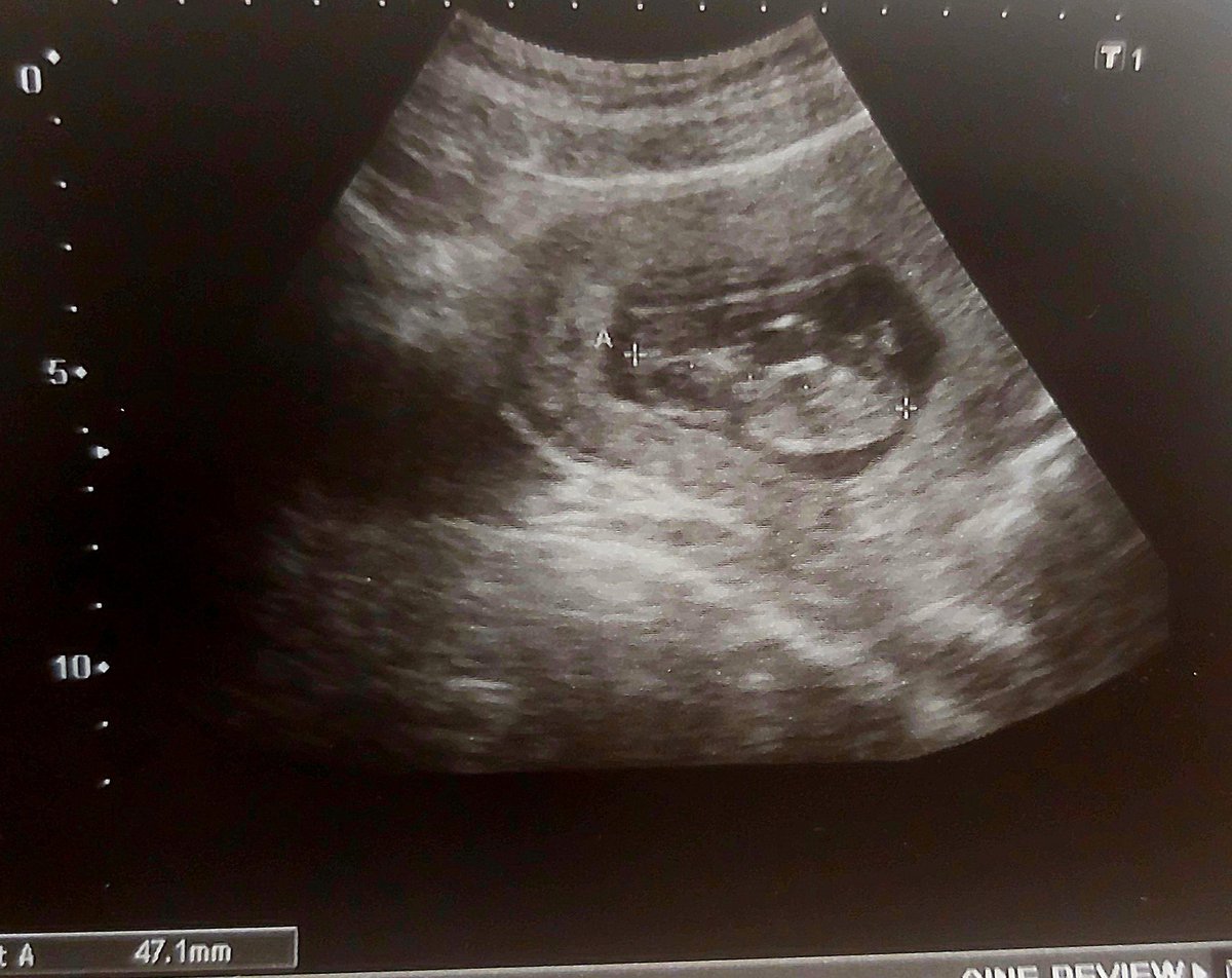 #infertilpreñis ayer tuve mi primera cita con obstetra y fue genial. La médico muy maja. Por primera vez me hicieron eco abdominal. 🦔 ha crecido mucho, ya mide 4,71 cm y se movía un montón!. Hoy he tenido el cribado y la semana que viene o la otra la eco de la 12.  Qué ilusión!
