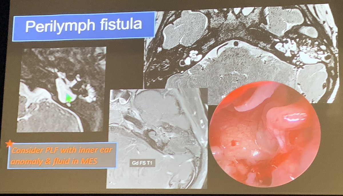 ESHNR (@eshnrsociety) on Twitter photo Consider perilymph fistula with inner ear anomaly and fluid in MES!
<a href="/callyrobs/">Caroline Robson, MBChB</a> #ESHNR24 Consider perilymph fistula with inner ear anomaly and fluid in MES!
<a href="/callyrobs/">Caroline Robson, MBChB</a> #ESHNR24
