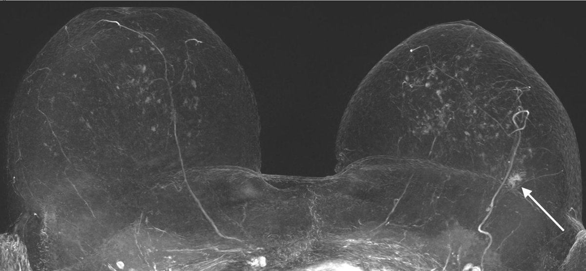 Antje Hellwich @antjehellwich.bsky.social (@antjehellwich) on Twitter photo Abbreviated Breast #MRI Protocol. Dr. Uwe Fischer & Dr. Friedemann Baum (Diagnostic Breast Cancer Center Göttingen) share their 3T MAGNETOM Lumina .exar1 file and give tips on patient preparation and imaging at magnetomworld.siemens-healthineers.com/clinical-corne…
#magnetomworld #BreastCancer <a href="/SiemensHealth/">Siemens Healthineers</a> Abbreviated Breast #MRI Protocol. Dr. Uwe Fischer & Dr. Friedemann Baum (Diagnostic Breast Cancer Center Göttingen) share their 3T MAGNETOM Lumina .exar1 file and give tips on patient preparation and imaging at magnetomworld.siemens-healthineers.com/clinical-corne…
#magnetomworld #BreastCancer <a href="/SiemensHealth/">Siemens Healthineers</a>
