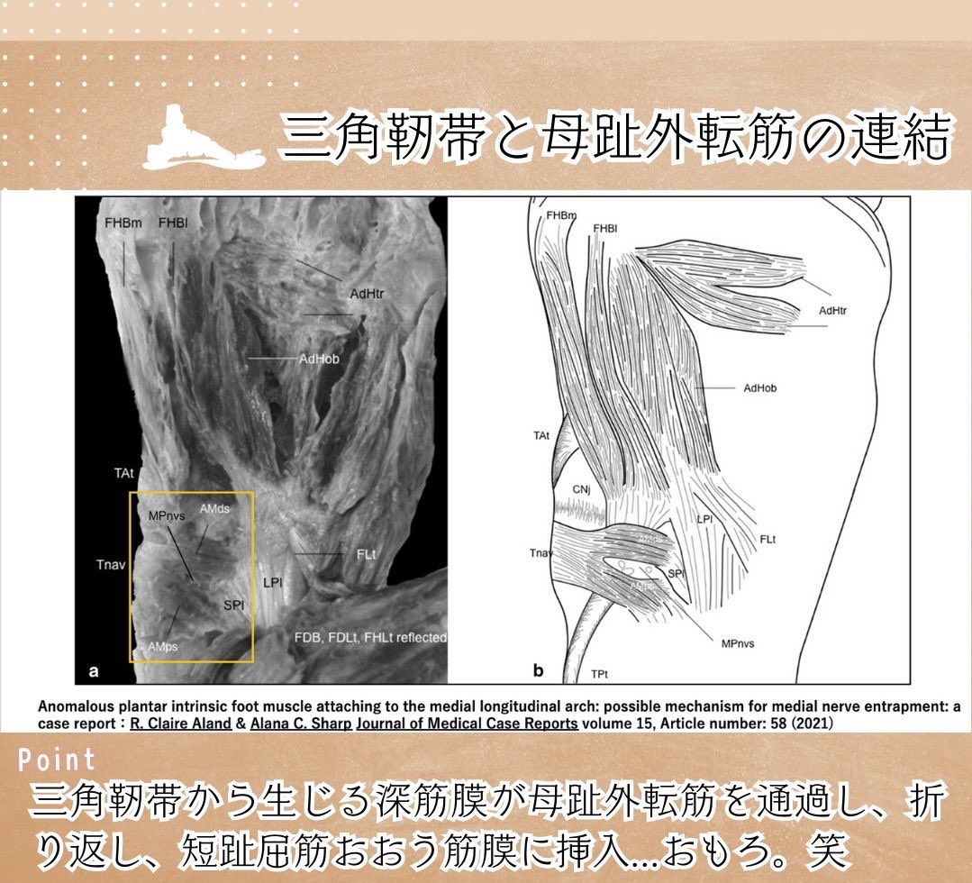 oshiroakito's tweet photo. 足部の研究報告まとめ🦶

最近では足部と歩行の
臨床研究も増えてる印象です。

実際に骨にピンを打ち込む
ぶっ飛び研究も。笑

ただ、全身との関連に関するものは
まだ少なくアートな要素も満載です。

だから足部がすきです。笑

#理学療法士
#続きはリプ欄
#Instagramはプロフへ
#姿勢反射おもろい https://t.co/vApY69GRby
