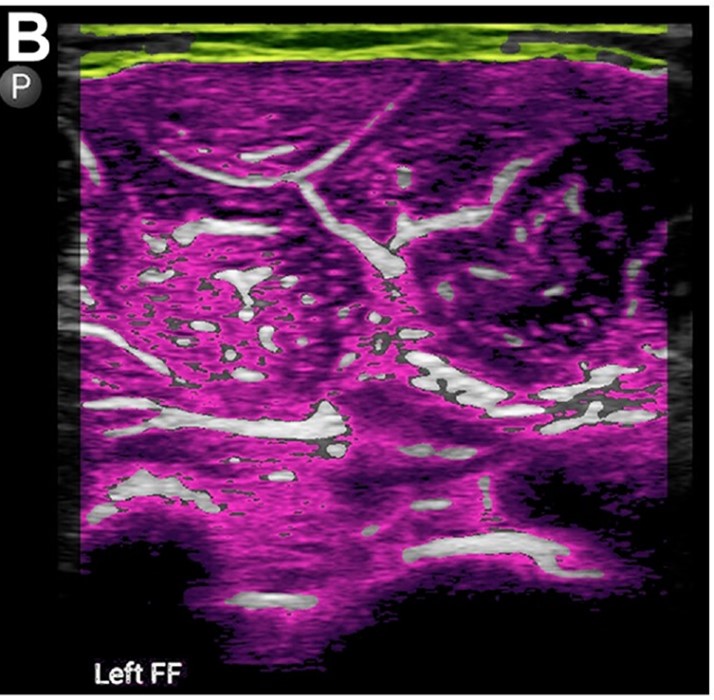 This study of youth baseball pitchers found a significant decrease in glycogen stores of the flexor-pronator mass and decreased grip strength after 75 pitches, but did not find any increase in medial elbow gapping

See the full study #OpenAccess here! ow.ly/CkBB50Tk5cZ