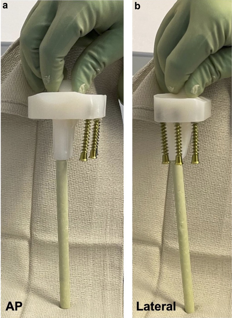 Arthroplasty Today (@arthrotoday) on Twitter photo This surgical technique paper from <a href="/IcahnMountSinai/">Icahn School of Medicine at Mount Sinai</a> ortho describes use of screws and cement for a severe proximal tibial defect in the setting of fungal prosthetic joint infection. <a href="/PaulosMengsteab/">Paulos Mengsteab MD PhD</a> <a href="/LockeAuston/">Auston Locke</a> @SChipknee <a href="/mike_miranda4/">Michael Miranda, DO, FAAOS</a>
arthroplastytoday.org/article/S2352-… This surgical technique paper from <a href="/IcahnMountSinai/">Icahn School of Medicine at Mount Sinai</a> ortho describes use of screws and cement for a severe proximal tibial defect in the setting of fungal prosthetic joint infection. <a href="/PaulosMengsteab/">Paulos Mengsteab MD PhD</a> <a href="/LockeAuston/">Auston Locke</a> @SChipknee <a href="/mike_miranda4/">Michael Miranda, DO, FAAOS</a>
arthroplastytoday.org/article/S2352-…