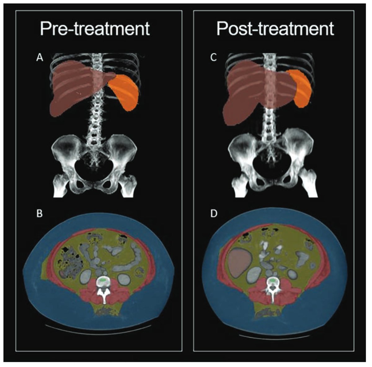 Automated CT-based AI tools reveal potentially important changes in body composition in patients with semaglutide use, not evident from anthropometric or other clinical measures.

ajronline.org/doi/10.2214/AJ…