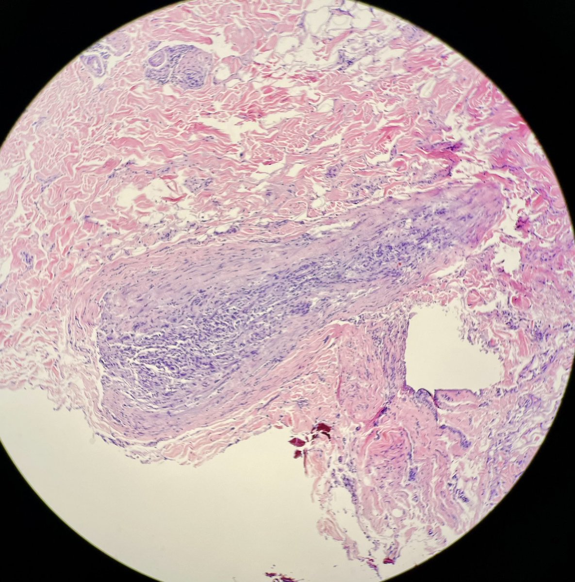 Most extensive peri- and intraneural invasion of SCC I have seen… #dermapath #mohs #dermatology

I was going to add more pictures but only 4 pictures are allowed. There were significant neurotropism in every single nerves in dermis with this kind of finding.
